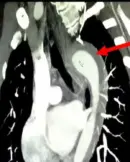 aorta (1)