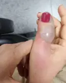 mulher-tem-infeccao-apos-fazer-as-unhas-e-passa-por-4-cirurgias-2812231-article (1) (1)